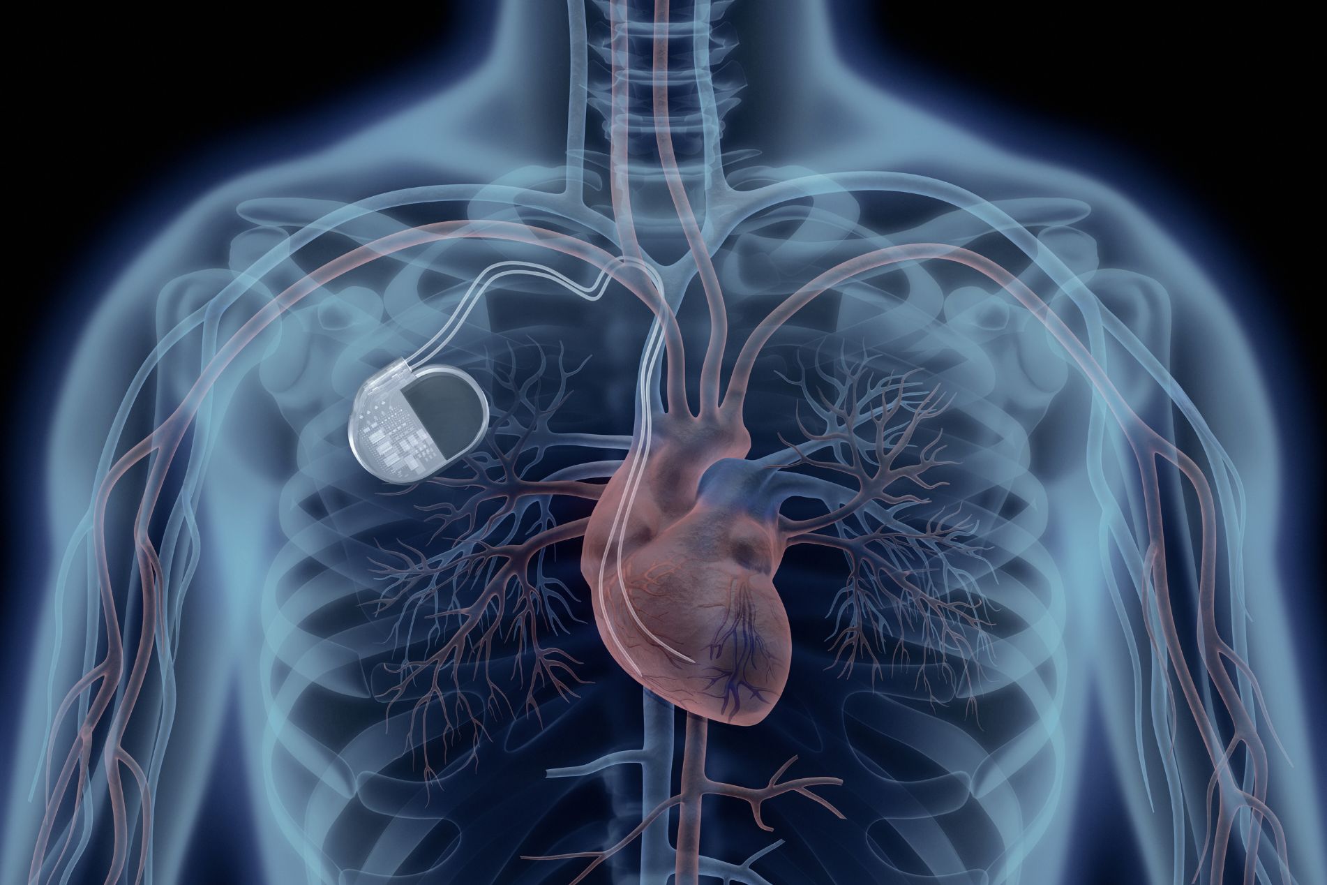 Illustration Therapie mittels Herzimplantat